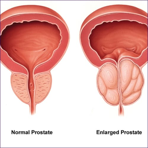 Prostate Care Reiki Energy System